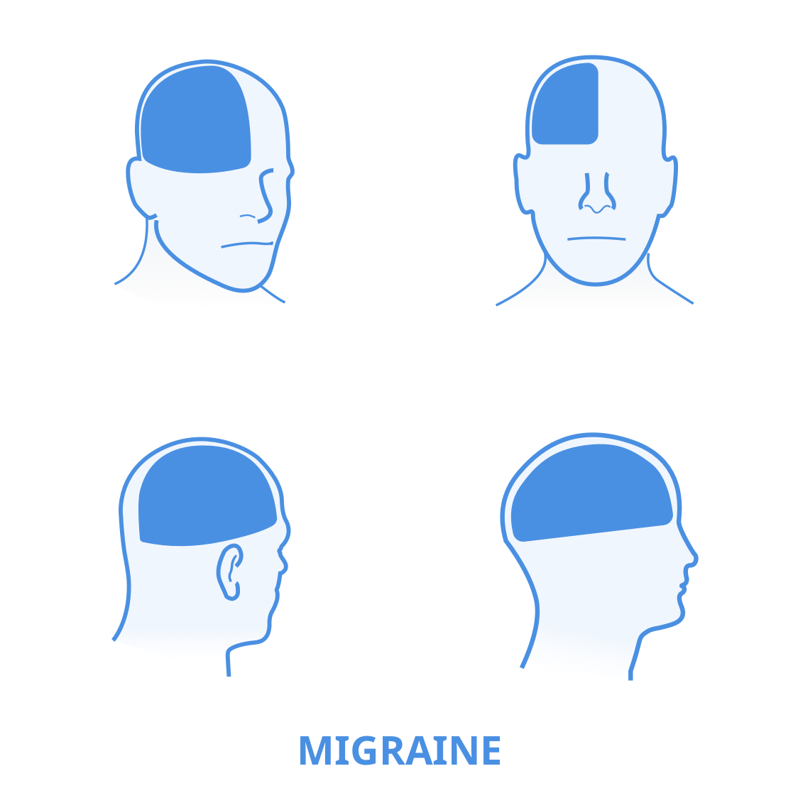 Different types of migraines